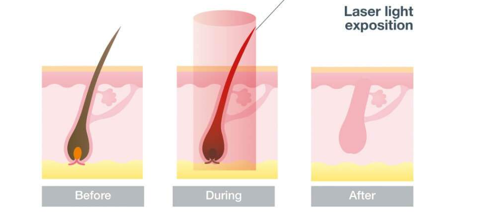 Introduction about Diode laser hair removal