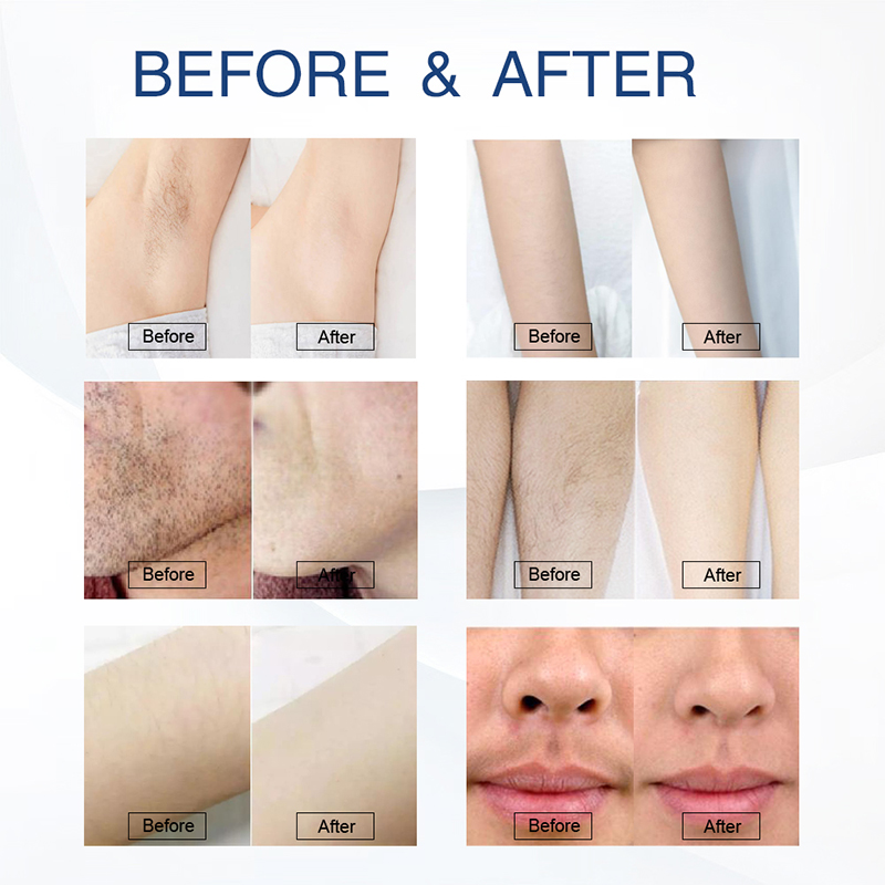 Revolutionizing Hair Removal with the 808 Diode Laser Hair Removal Machine