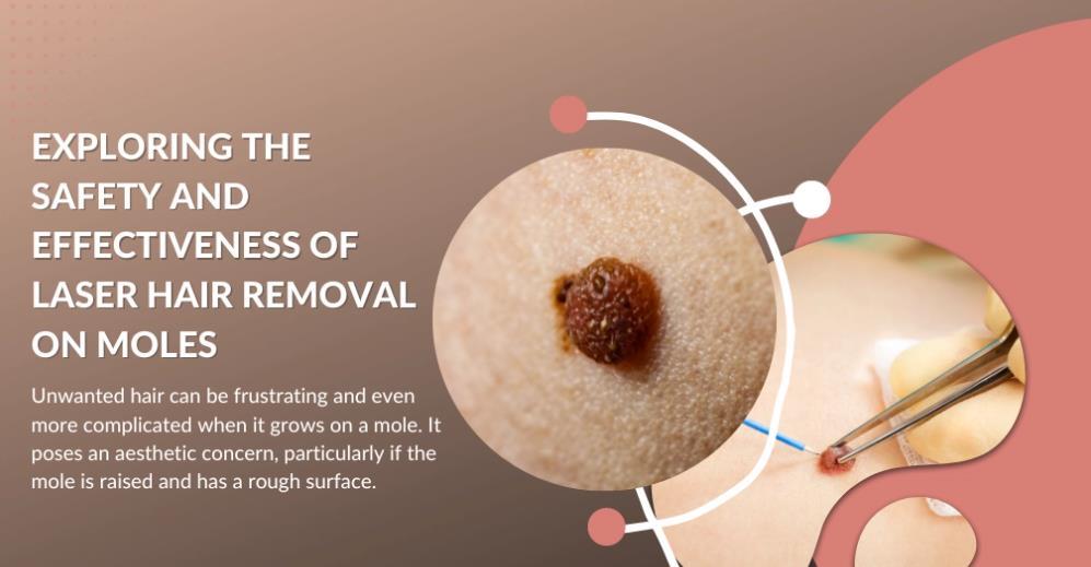 Is laser removal of leg hair and laser hair removal moles safe?