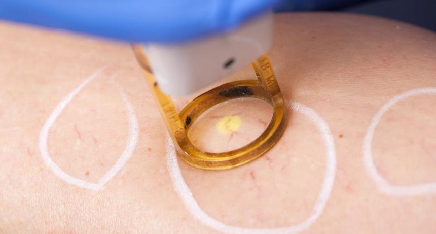 What is Spider Veins Removal?